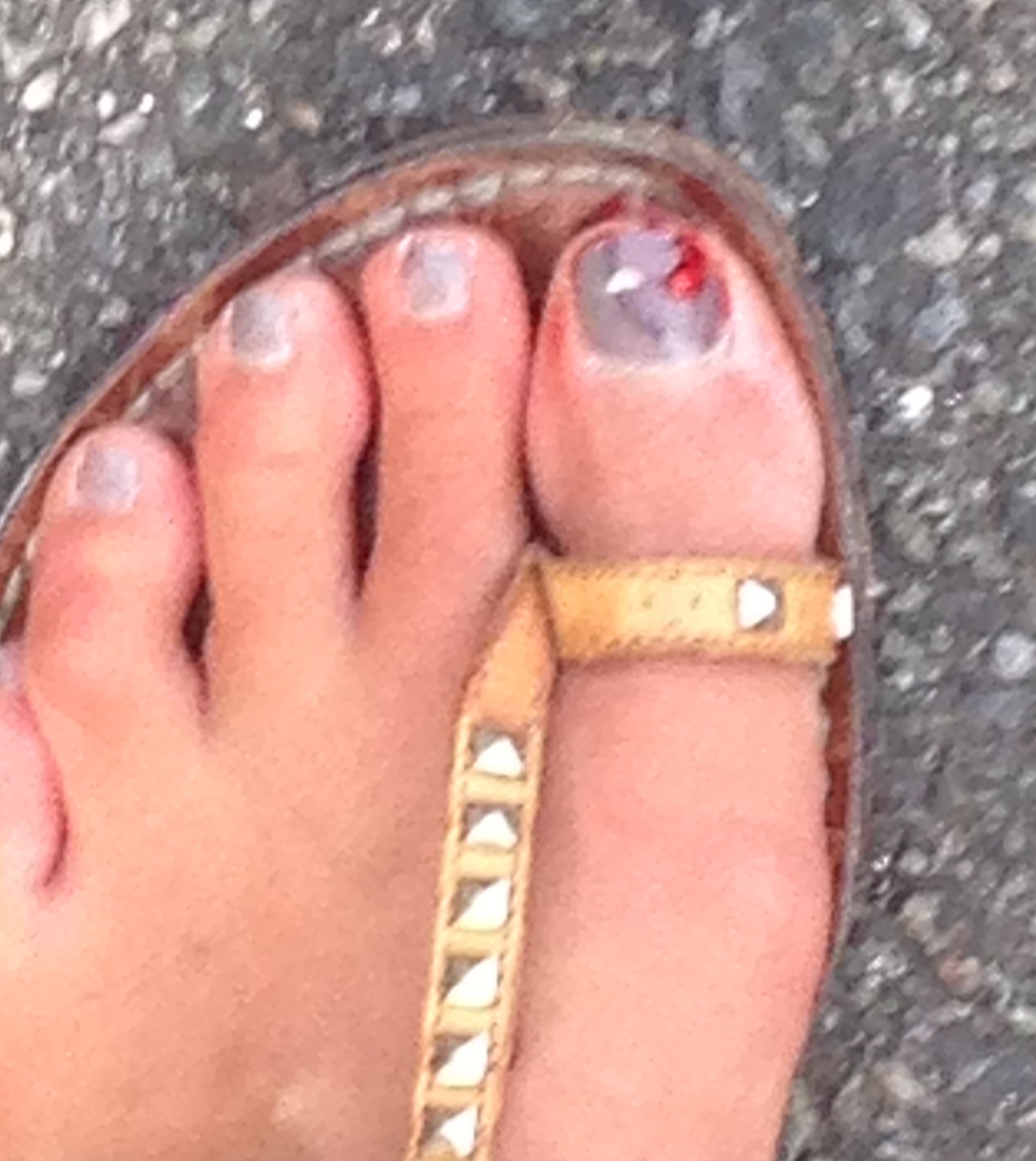 broken toes | SurfaceFine broken toes | SurfaceFine