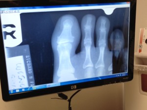 toe xray